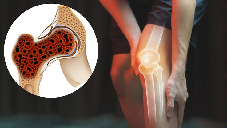 ہڈی کا کینسر (Bone Cancer): عام درد سمجھ کر ان ابتدائی علامات کو نظر انداز نہ کریں، جانیں آنکولوجسٹ کیا کہتے ہیں